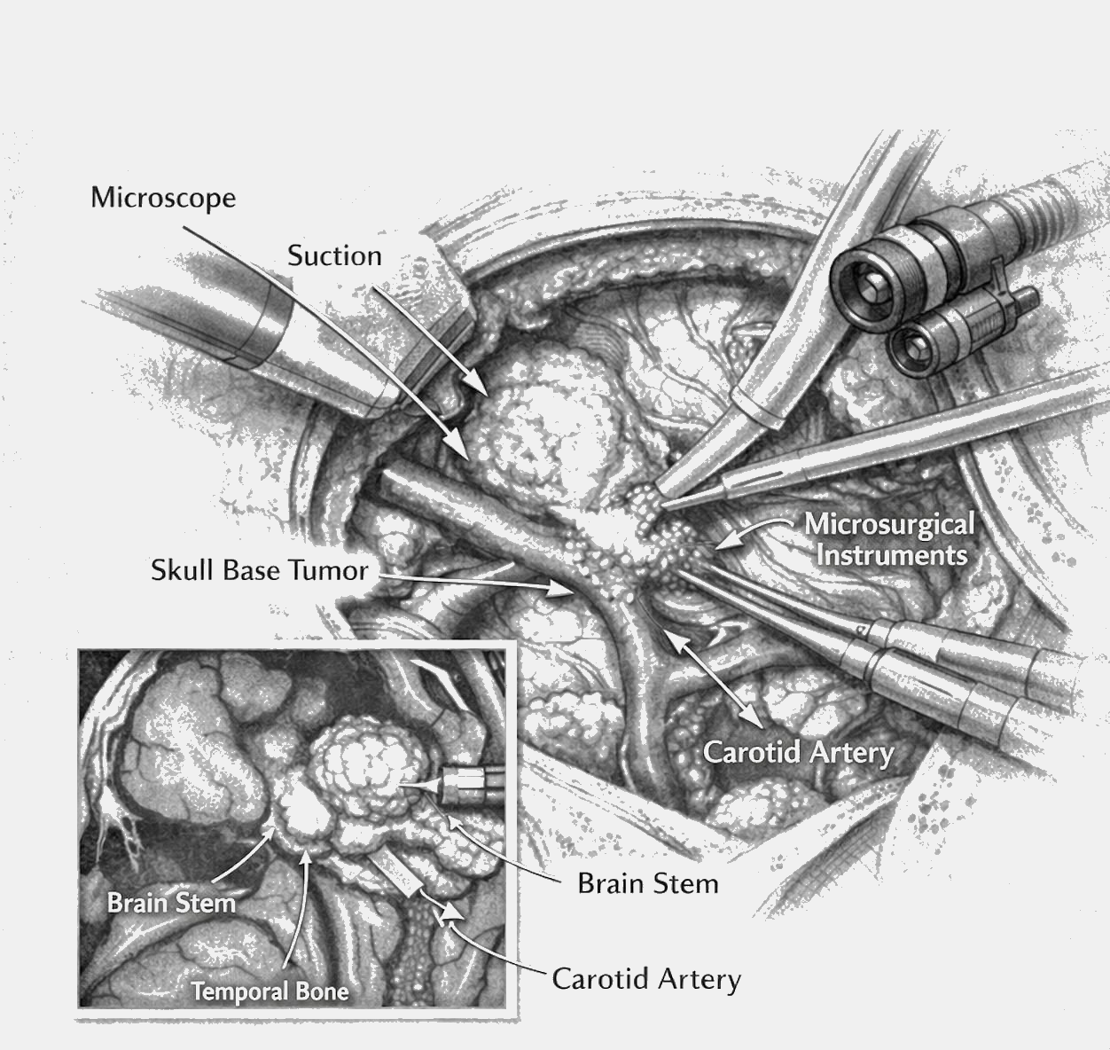 Skull Base Tumour Surgery in Hyderabad