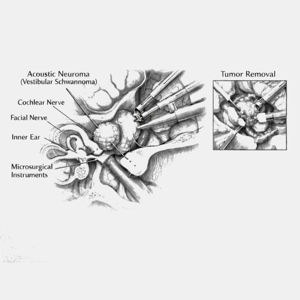 Acoustic Neuroma Surgery in Hyderabadb