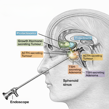 Hormone secreting pituitary tumour treatment in Hyderabad, surgery for acromegaly and Cushing's disease