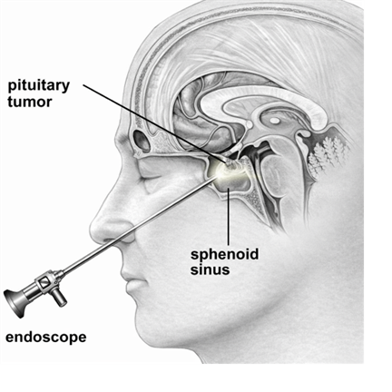 Endoscopic pituitary tumour surgery in Hyderabad, minimally invasive transsphenoidal approach