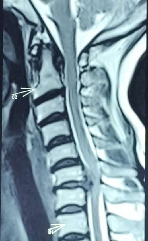 Sagittal mri of cervical spine showing slipped disc and spinal cord compression, diagnosed by dr. Sai shiva, neurosurgeon in lb nagar, hyderabad | dr. Sai shiva tadakamalla Sagittal MRI of cervical spine showing slipped disc and spinal cord compression, diagnosed by Dr. Sai Shiva, neurosurgeon in LB Nagar, Hyderabad