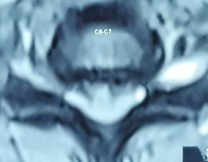 Axial MRI scan at C6-C7 level showing disc prolapse compressing spinal cord, treated by Dr. Sai Shiva, Gleneagles Aware Hospital, Hyderabad