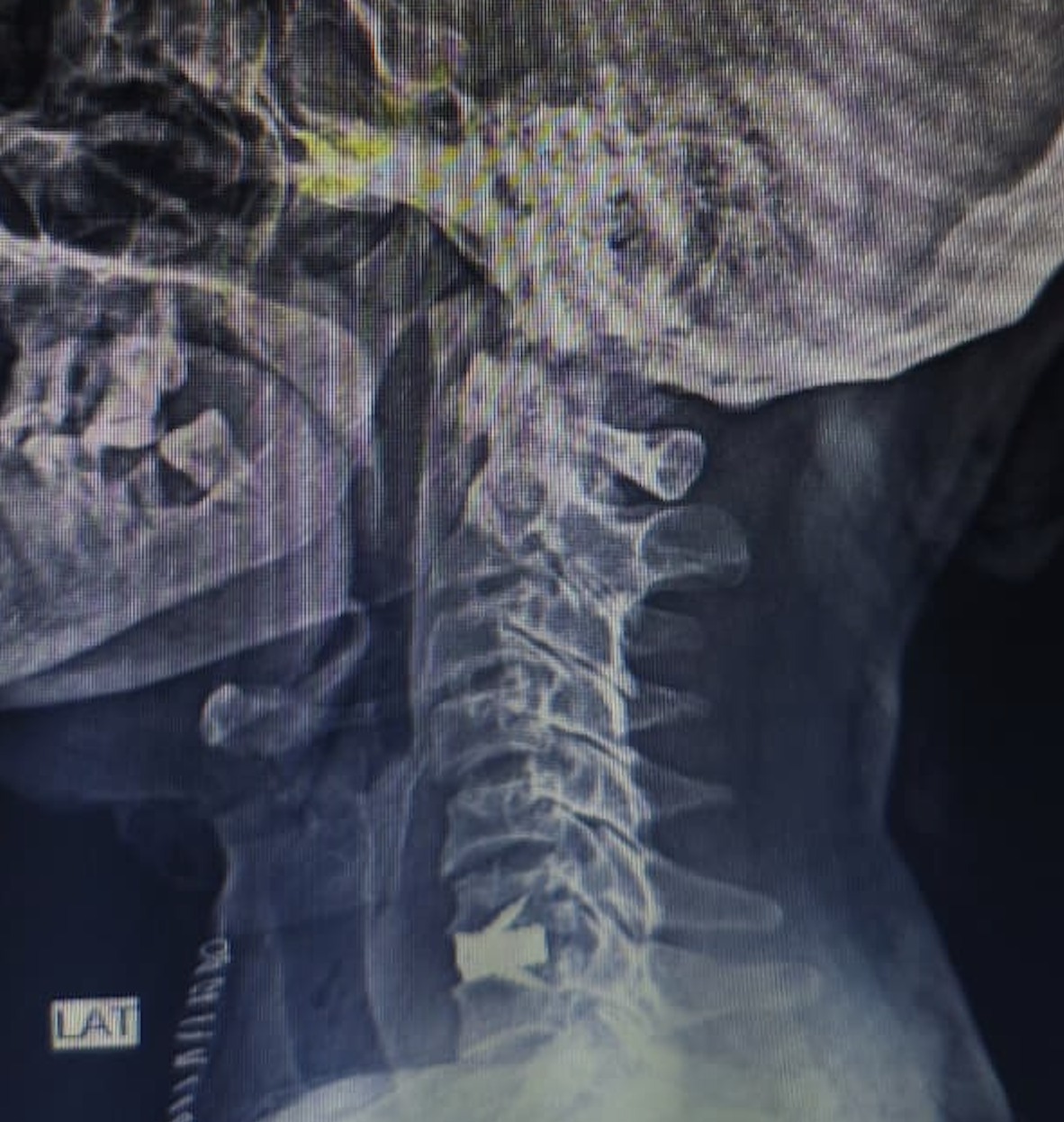 Post-operative lateral x-ray of cervical spine with stand-alone cage after acdf surgery by dr. Sai shiva, neurosurgeon in lb nagar, hyderabad | dr. Sai shiva tadakamalla Post-operative lateral X-ray of cervical spine with stand-alone cage after ACDF surgery by Dr. Sai Shiva, neurosurgeon in LB Nagar, Hyderabad