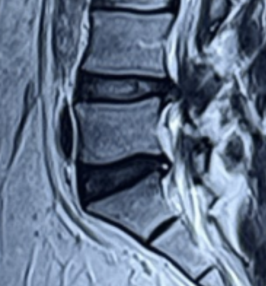 Sagittal MRI of lumbar spine showing L4-L5 disc prolapse and canal narrowing, diagnosed by Dr. Sai Shiva, neurosurgeon in LB Nagar, Hyderabad