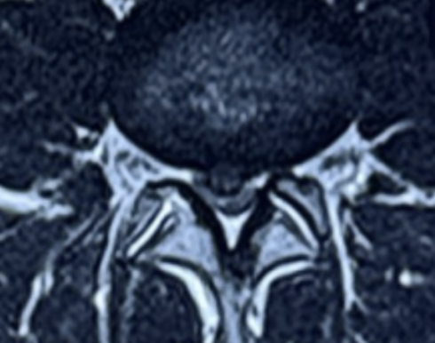 Axial MRI scan showing L4-L5 disc herniation compressing bilateral nerve roots, treated by Dr. Sai Shiva, spine surgeon in Hyderabad