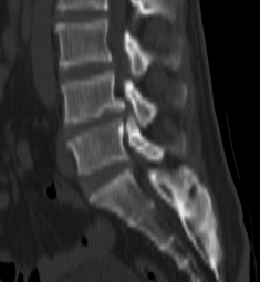 Sagittal CT scan of lumbar spine showing L4-L5 disc prolapse and spinal canal stenosis, treated by Dr. Sai Shiva, Gleneagles Aware Hospital, Hyderabad