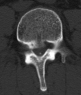 Axial CT scan of lumbar spine showing disc prolapse and canal narrowing before laminectomy and discectomy by Dr. Sai Shiva, spine surgeon in LB Nagar, Hyderabad