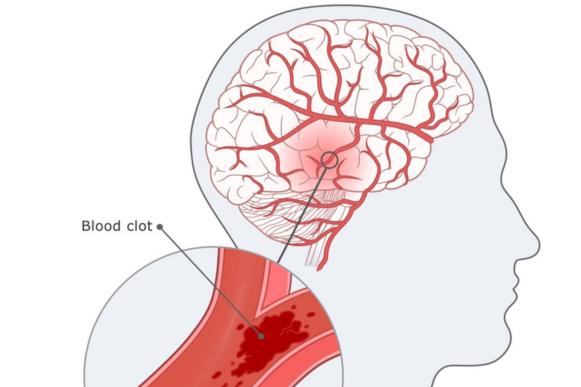Illustration showing temporary blood vessel blockage in the brain during a transient ischemic attack or mini stroke in an elderly patient