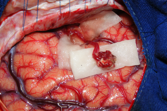 Hormone secreting pituitary tumour treatment in Hyderabad, surgery for acromegaly and Cushing's disease