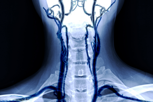 Hormone secreting pituitary tumour treatment in Hyderabad, surgery for acromegaly and Cushing's disease
