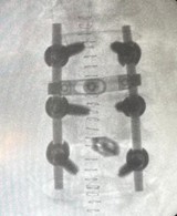 Post-operative AP X-ray showing spinal fixation at L3-L5 and PLIF at L4-L5 performed by Dr. Sai Shiva, spine surgeon in LB Nagar, Hyderabad