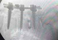 Post-operative lateral X-ray showing spinal instrumentation and L4-L5 interbody fusion, performed by Dr. Sai Shiva, Gleneagles Aware Hospital, Hyderabad