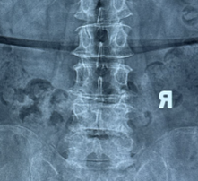 Axial MRI scan showing L4-L5 disc herniation and bilateral nerve root compression, treated by Dr. Sai Shiva, spine surgeon in Hyderabad
