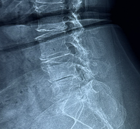 Pre-operative AP X-ray of lumbar spine showing degenerative changes and canal narrowing in a 64-year-old patient, Dr. Sai Shiva, Hyderabad