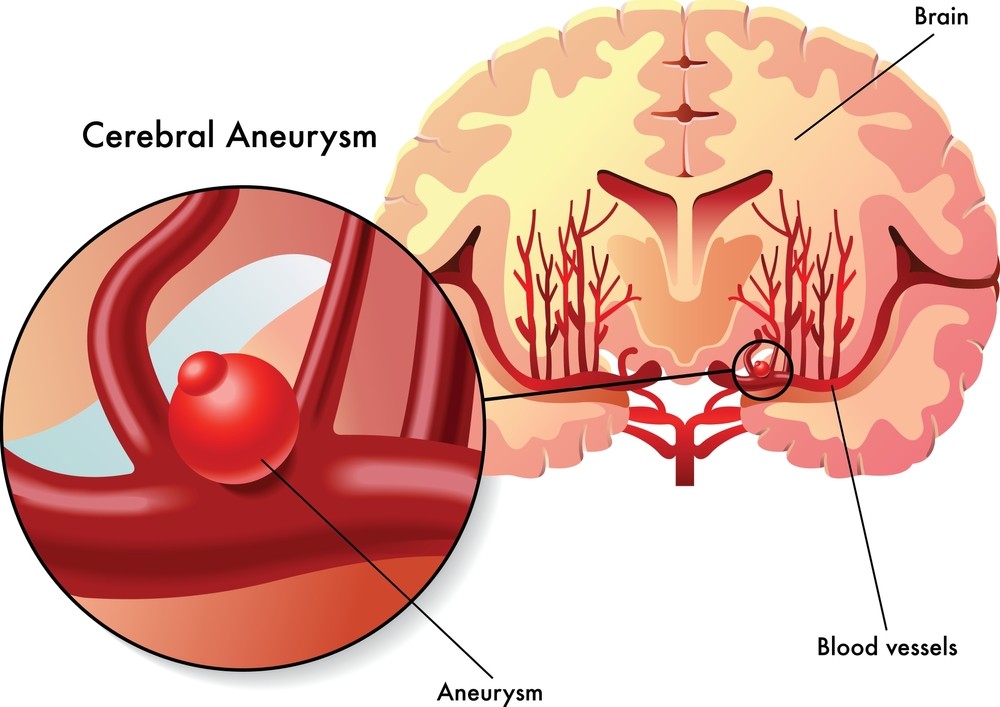 Endoscopic pituitary tumour surgery in Hyderabad, minimally invasive transsphenoidal approach