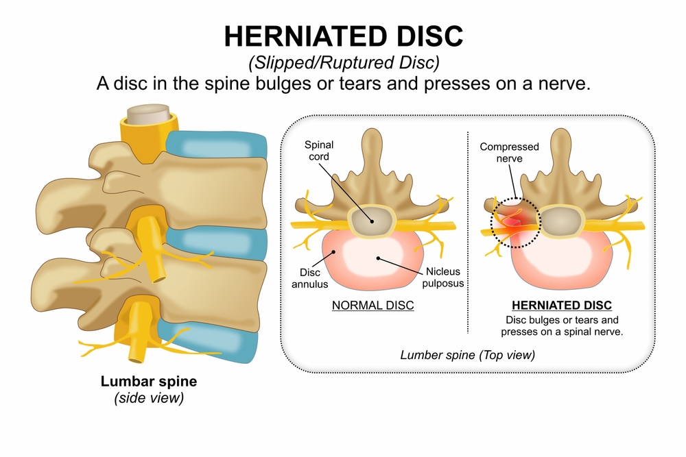 Endoscopic pituitary tumour surgery in Hyderabad, minimally invasive transsphenoidal approach