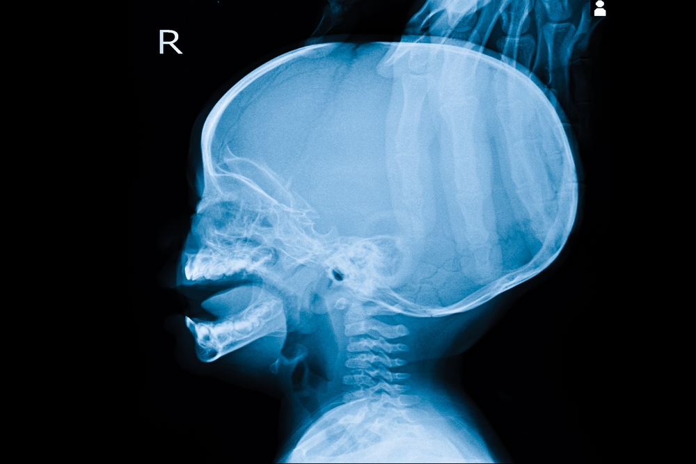 Endoscopic pituitary tumour surgery in Hyderabad, minimally invasive transsphenoidal approach