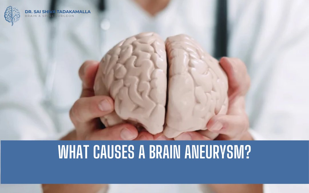 What Causes a Brain Aneurysm
