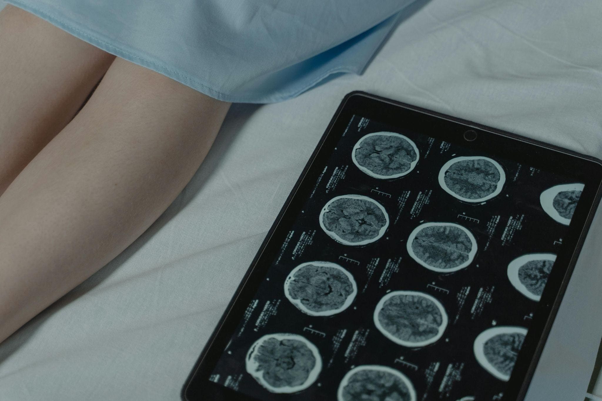Hormone secreting pituitary tumour treatment in Hyderabad, surgery for acromegaly and Cushing's disease