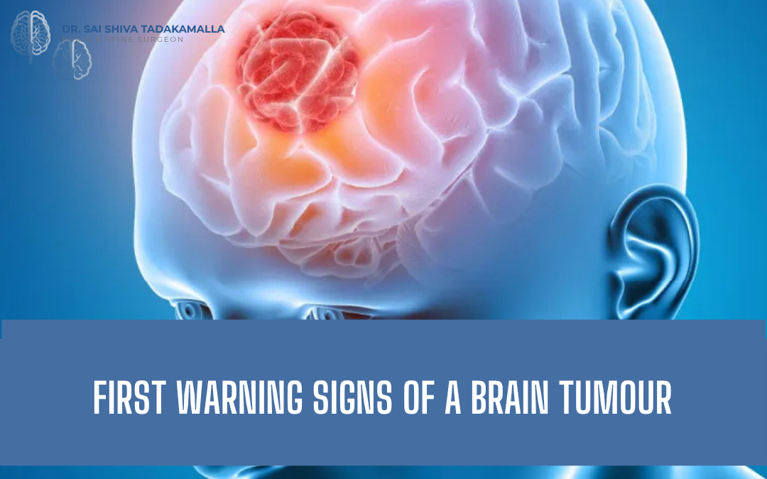 First Warning Signs of a Brain Tumour