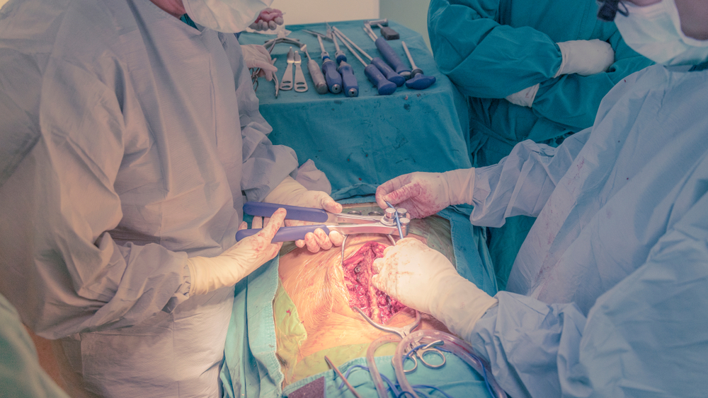 Surgeons in sterile gowns perform open abdominal surgery, exposing tissue and using surgical instruments.