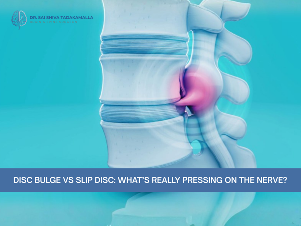 3D illustration of a section of the lumbar spine showing a bulging/slipped disc pressing on a nerve, highlighting disc herniation concepts for educational purposes.