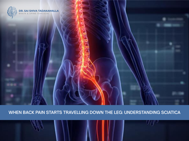 Back view of the spine and leg with the sciatic nerve highlighted in red, accompanying the article title about understanding sciatica in the banner.